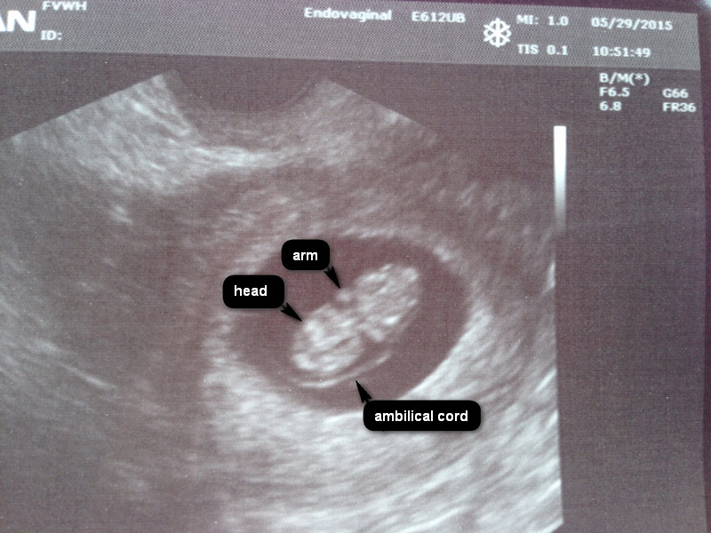 First Sonogram Picture