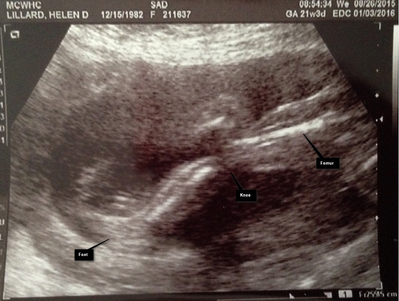 First Sonogram Picture