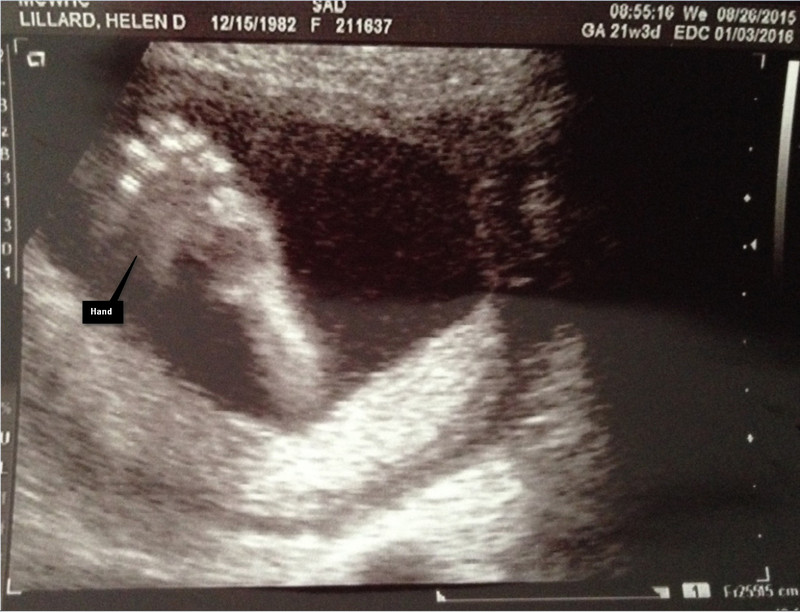 First Sonogram Picture
