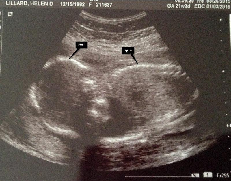 First Sonogram Picture