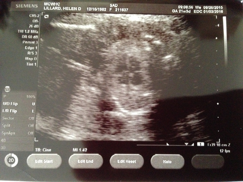 First Sonogram Picture