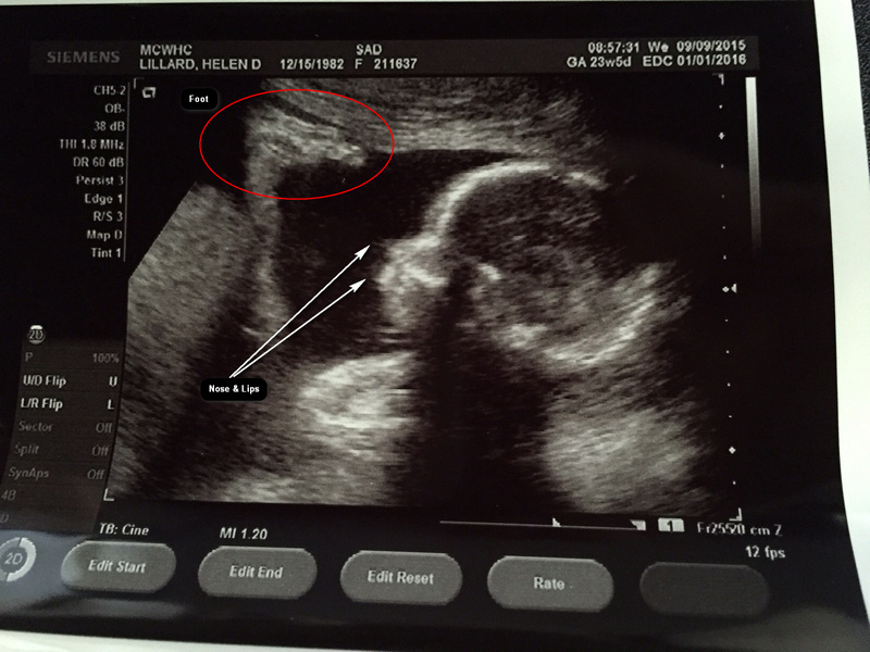 First Sonogram Picture