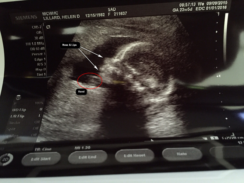 First Sonogram Picture