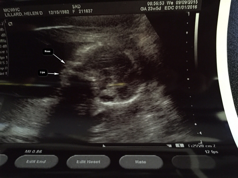 First Sonogram Picture