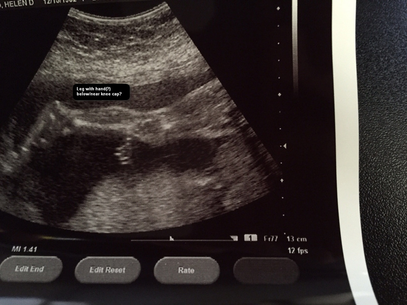First Sonogram Picture