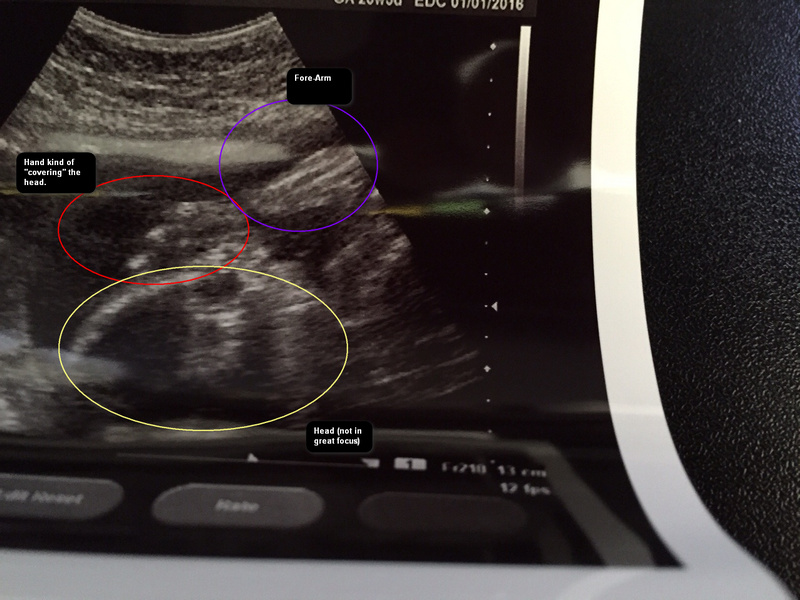 First Sonogram Picture